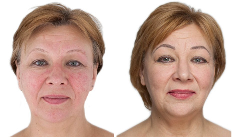 ODA Klinika atsiliepimai veido raudonis gydymas Danguolė
