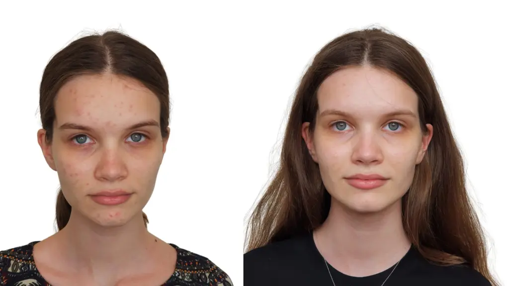 Gabijos odos gydymo rezultatai