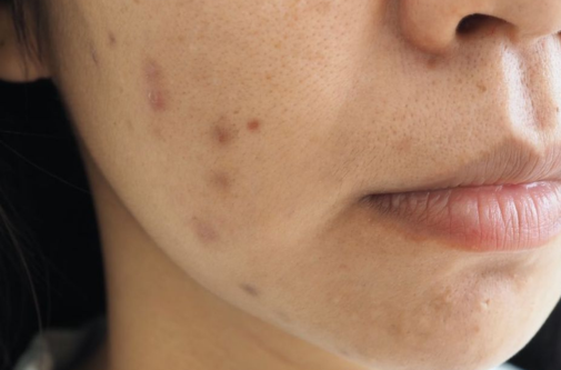 1 Bėrimai ant veido